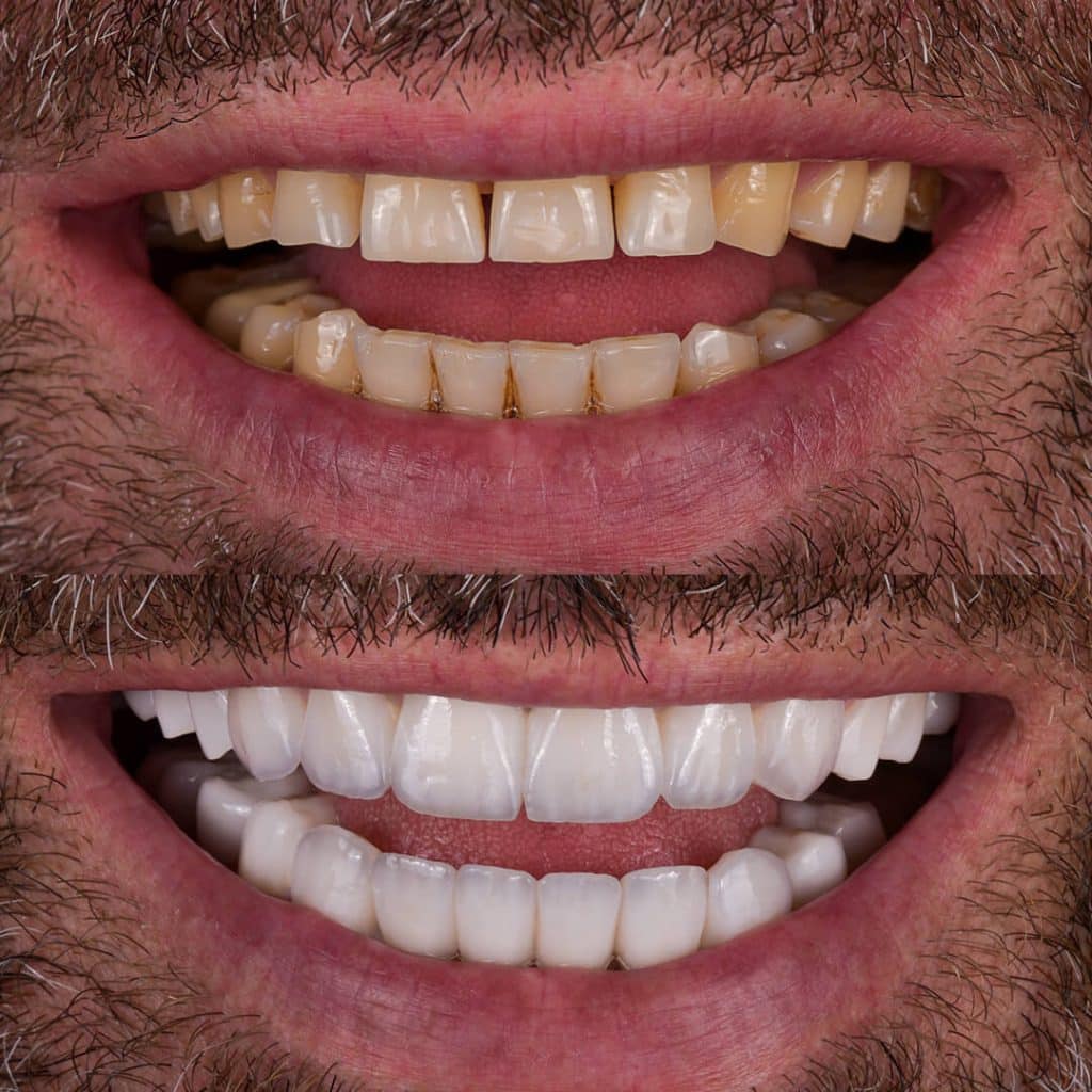 Frequently Asked Questions About Implant Treatment and Smile Design in Turkey