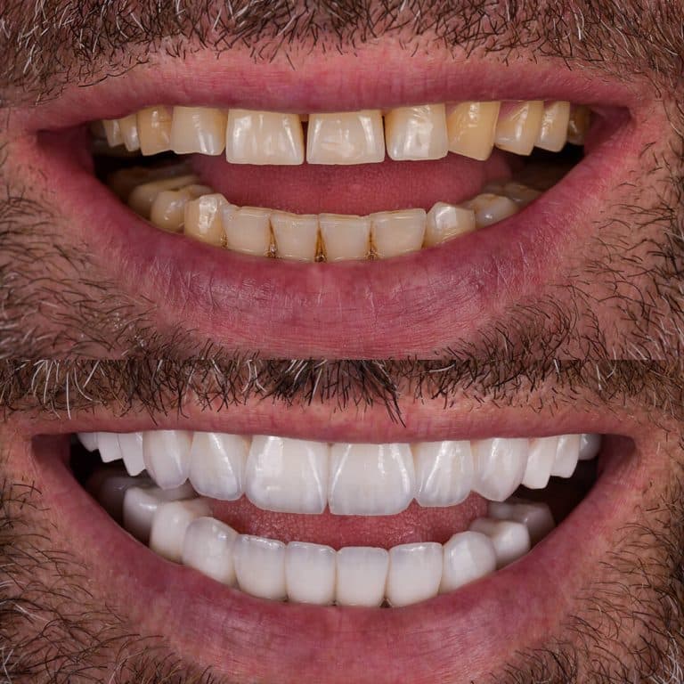 Frequently Asked Questions About Implant Treatment and Smile Design in Turkey