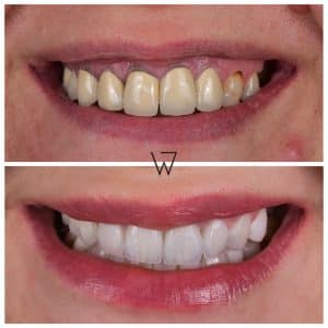 dental implants turkey
