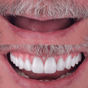 turkey teeth