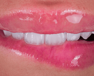 non prep veneers in turkey
