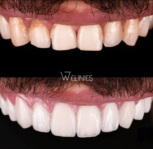 Frequently Asked Questions on Dental Implant Procedure in Turkey