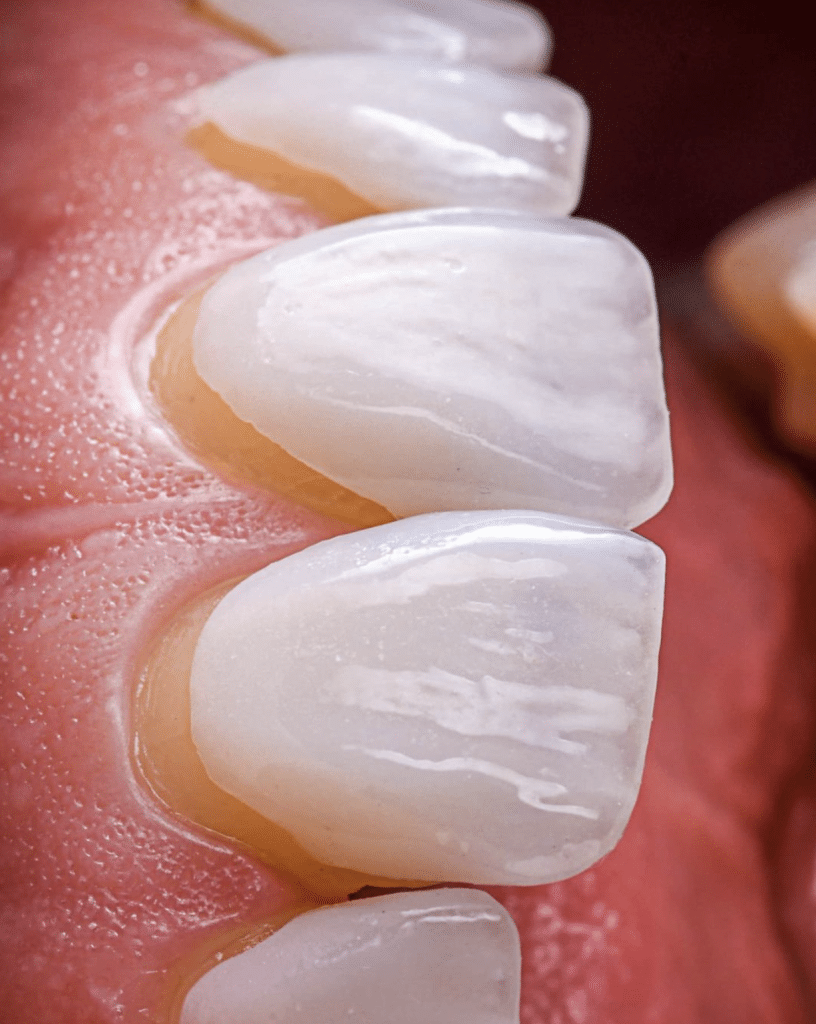 full mouth restoration istanbul