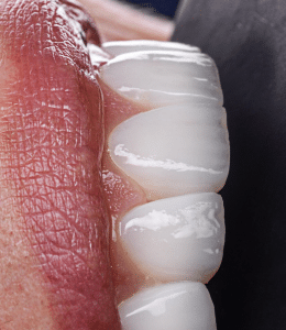 transcluent veneers full mouth smile design