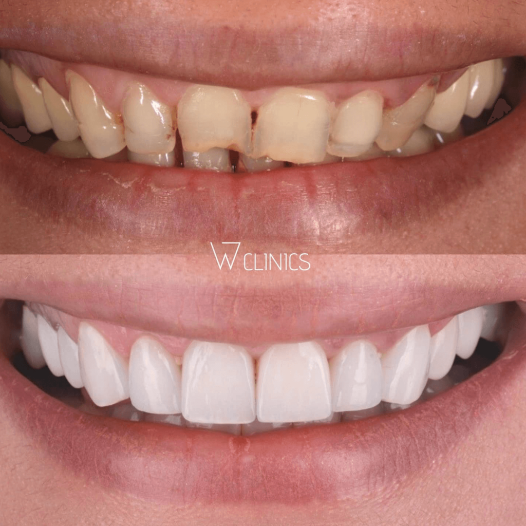 How much does it cost to get teeth done in Turkey?