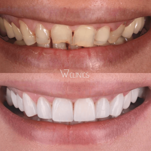 How much does it cost to get teeth done in Turkey?