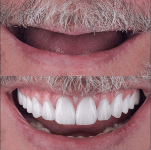 full mouth implants